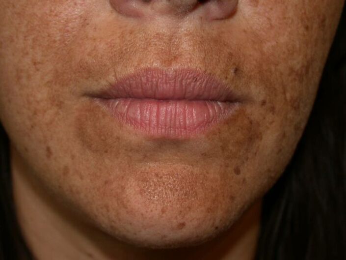 Les taches pigmentaires sur le visage sont une indication de la chirurgie au laser