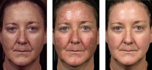 avant et après rajeunissement fractionné de la peau photo 2