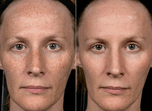 avant et après rajeunissement fractionné de la peau photo 3