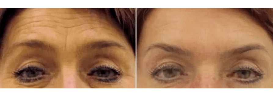 Appareils de rajeunissement fractionné