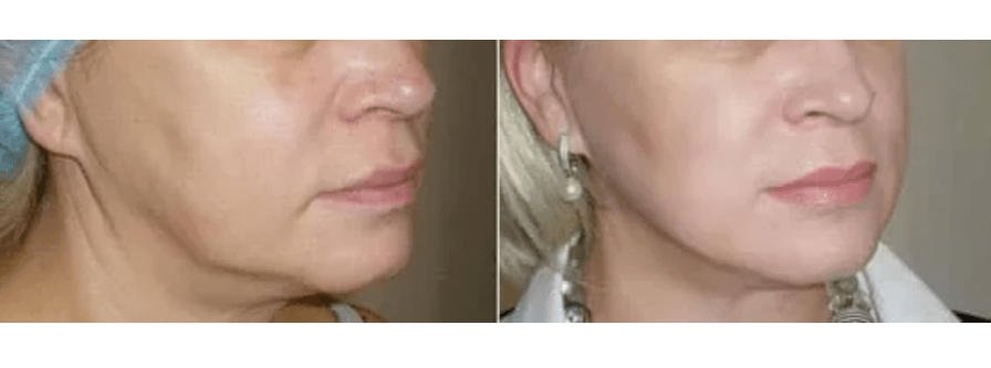 Récupération après rajeunissement de la peau